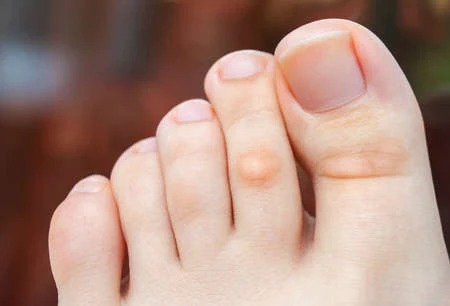 足指が変形するのはなぜ？